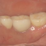 奥歯（大臼歯）に使用する材質は何がよいのか