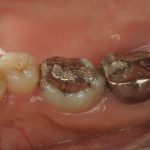 虫歯の再治療を繰り返すとどうなるか