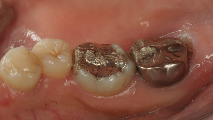 虫歯の再治療を繰り返すとどうなるか