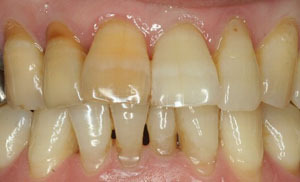 前歯の着色した歯をどう治すか？