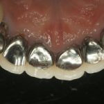 「審美歯科では金属は使用しません。　・・・前歯の裏側を見る」