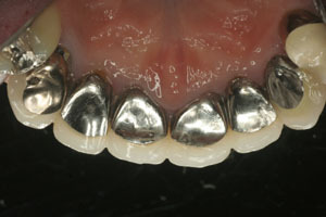 「審美歯科では金属は使用しません。　・・・前歯の裏側を見る」