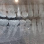 歯の骨への癒着