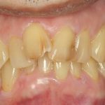 歯列不正はやっぱり虫歯や歯周病になりやすい