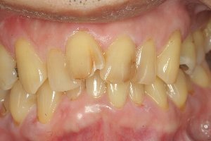 歯列不正はやっぱり虫歯や歯周病になりやすい