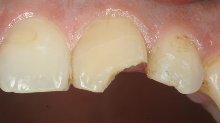 抜歯を伴う外傷における歯科治療について