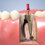 歯の痛みと腫れは再治療が原因
