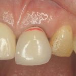 伸びた歯は咬み合わせに影響する？