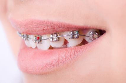 きれいな前歯を手に入れるためには矯正治療が必要な事もありあます。