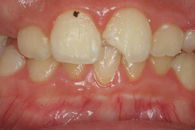 こだわり歯科医の本音の歯科講座-歯の外傷１