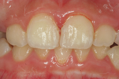 こだわり歯科医の本音の歯科講座-歯の外傷２