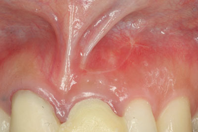 山形歯医者こだわり歯科医が語る本音の歯科講座-歯根のう胞