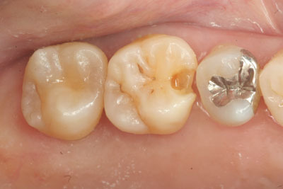 山形歯医者こだわり歯科医が語る本音の歯科講座-コンポジットレジン治療前