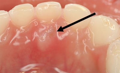 山形歯医者こだわり歯科医が語る本音の歯科講座-前歯の永久歯