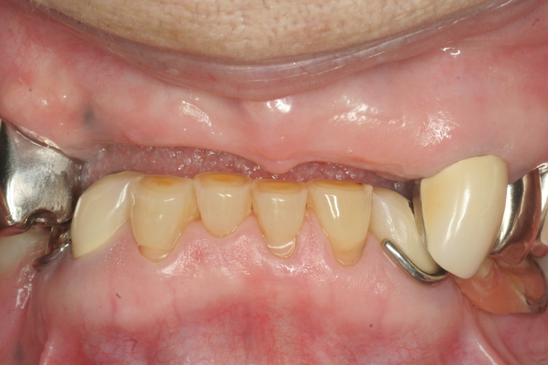 山形歯医者こだわり歯科医が語る本音の歯科講座-入れ歯の隙間