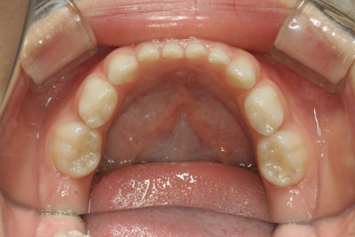 山形歯医者こだわり歯科医が語る本音の歯科講座-小児矯正4歳