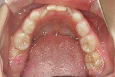 山形歯医者こだわり歯科医が語る本音の歯科講座-小児矯正5歳