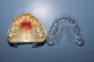 山形歯医者こだわり歯科医が語る本音の歯科講座-マウスピース形矯正装置