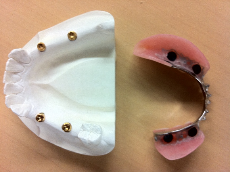 山形歯医者こだわり歯科医が語る本音の歯科講座-インプラント入れ歯